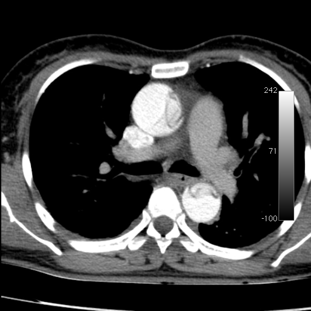 Aortic dissection - Stanford type A (Radiopaedia 29247-29659 A 32).jpg