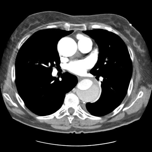 File:Aortic dissection - Stanford type B (Radiopaedia 50171-55512 A 26).png