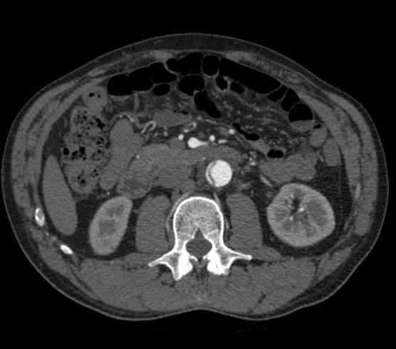 Aortic dissection - Stanford type B (Radiopaedia 73648-84437 A 155).jpg