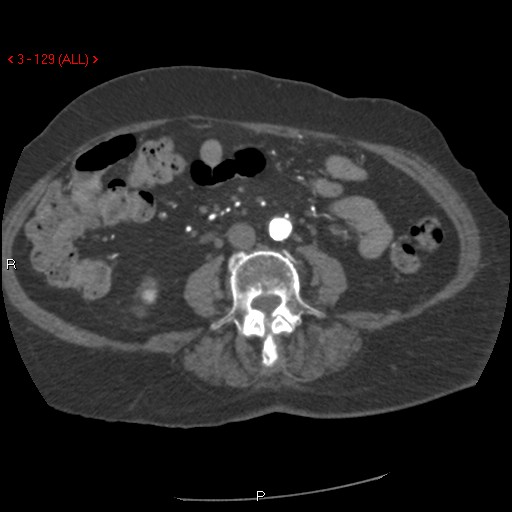 File:Aortic intramural hematoma (Radiopaedia 27746-28001 A 129).jpg
