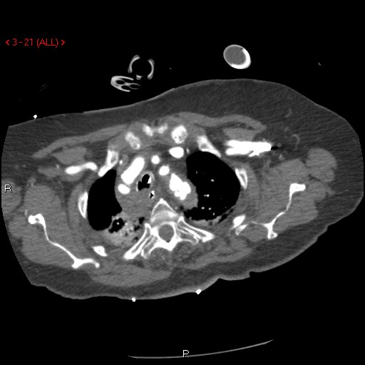 Aortic intramural hematoma (Radiopaedia 27746-28001 A 21).jpg