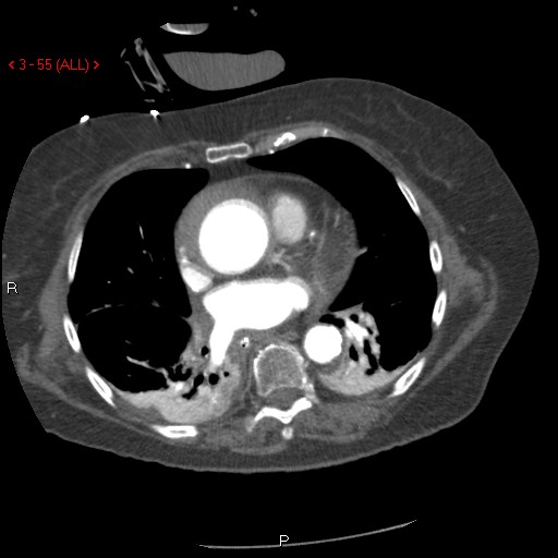 Aortic intramural hematoma (Radiopaedia 27746-28001 A 55).jpg