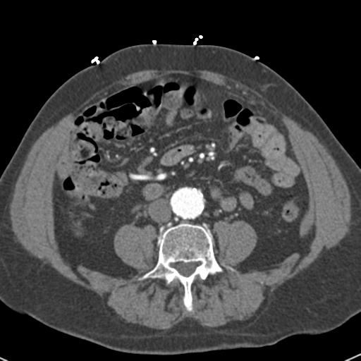 Aortic intramural hematoma (Radiopaedia 31139-31838 B 119).jpg