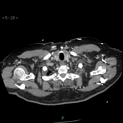 Aortic intramural hematoma (Radiopaedia 48463-53380 C 14).jpg