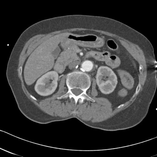 Aortic intramural hematoma from penetrating atherosclerotic ulcer (Radiopaedia 31137-31836 A 100).jpg