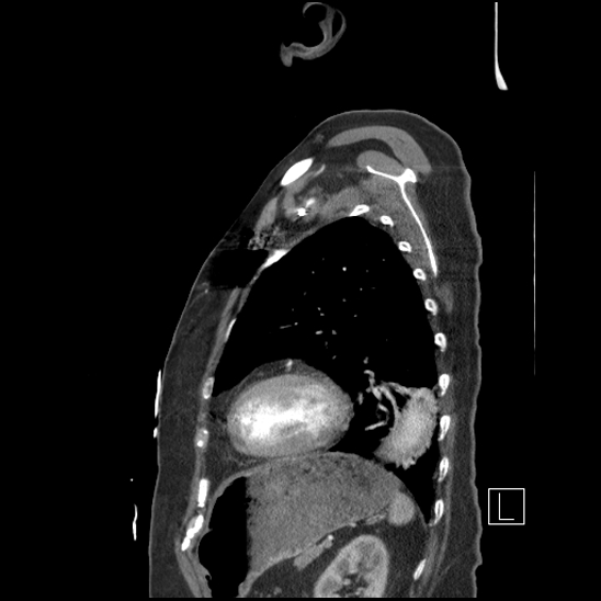 File:Aortic intramural hematoma with dissection and intramural blood pool (Radiopaedia 77373-89491 D 67).jpg