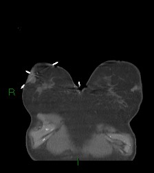 Aortic valve endocarditis (Radiopaedia 87209-103485 D 69).jpg