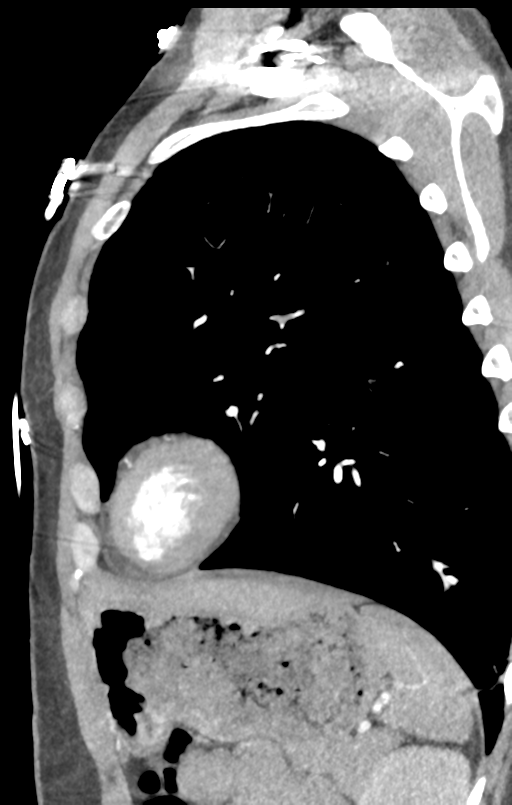 Aortic valve non-coronary cusp thrombus (Radiopaedia 55661-62189 C+ arterial phase 4).png