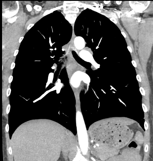 File:Aortic valve non-coronary cusp thrombus (Radiopaedia 55661-62189 C 45).png