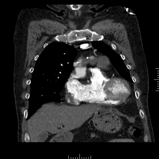 File:Aorto-coronary bypass graft aneurysms (Radiopaedia 40562-43157 B 12).png