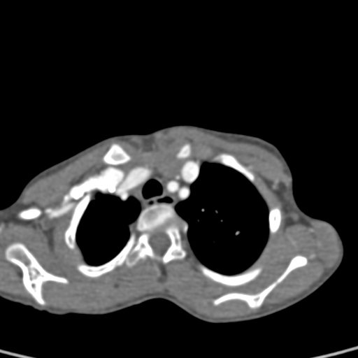 File:Aortopulmonary window, interrupted aortic arch and large PDA giving the descending aorta (Radiopaedia 35573-37074 B 14).jpg