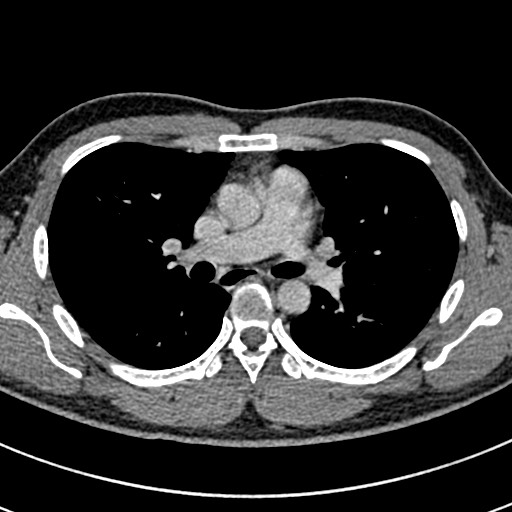 Apical lung mass mimic - neurogenic tumor (Radiopaedia 59918-67521 A 36).jpg
