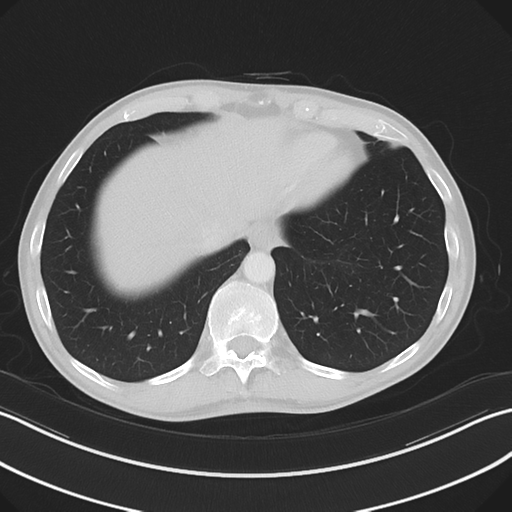Apical pleural calcification (Radiopaedia 46141-50499 Axial lung window 58).png