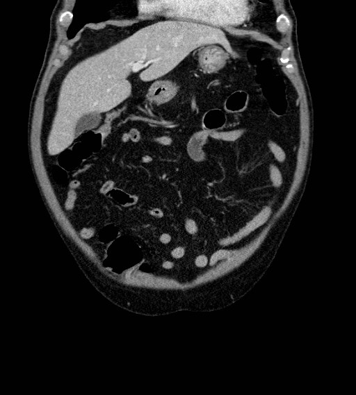File:Appendiceal adenocarcinoma complicated by retroperitoneal abscess (Radiopaedia 58007-65039 A 22).jpg