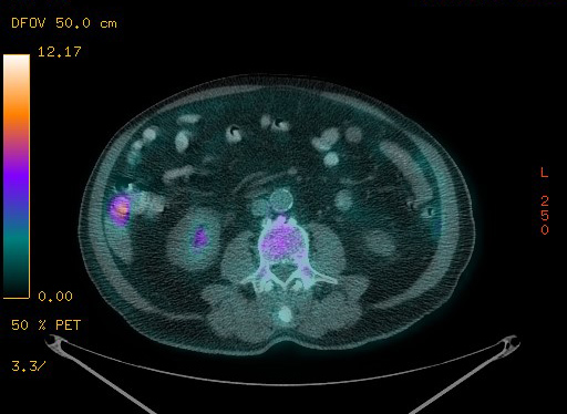 Appendiceal adenocarcinoma complicated by retroperitoneal abscess (Radiopaedia 58007-65041 Axial PET-CT 134).jpg