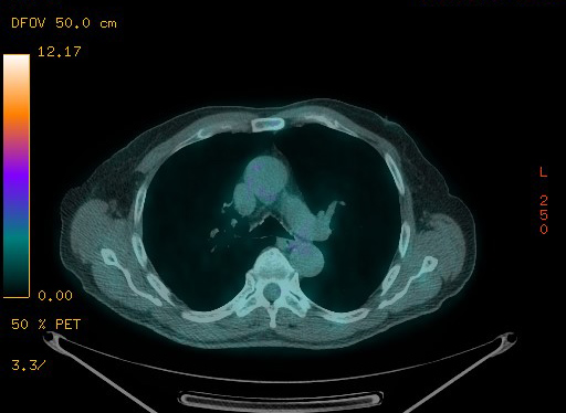 Appendiceal adenocarcinoma complicated by retroperitoneal abscess (Radiopaedia 58007-65041 Axial PET-CT 60).jpg