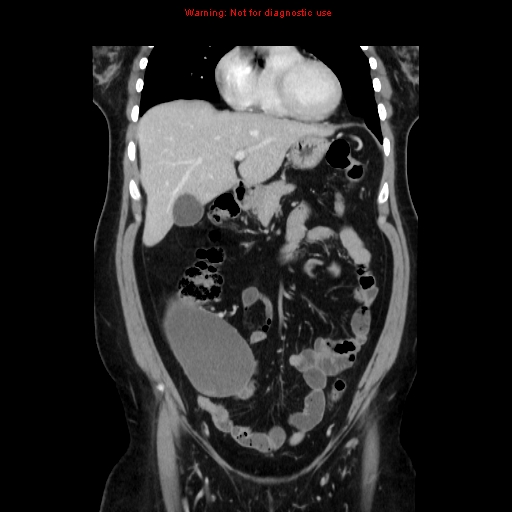 Appendiceal mucinous cystadenoma (Radiopaedia 8263-9111 B 25).jpg
