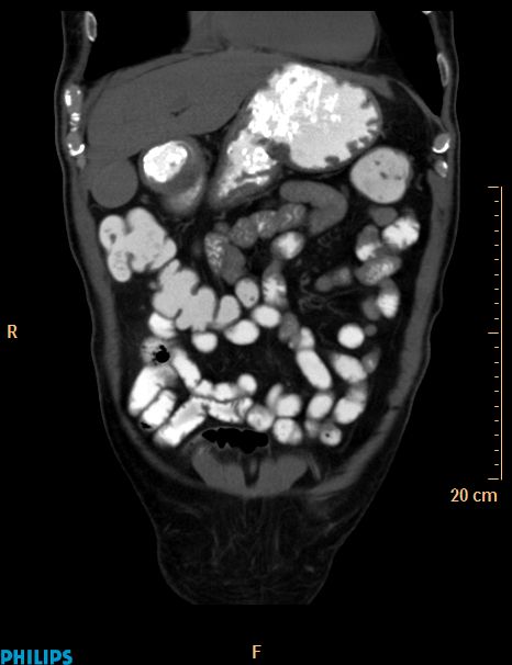 Appendiceal mucocoele (Radiopaedia 29449-29917 E 47).jpg