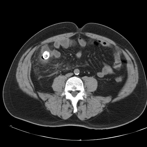 File:Appendicitis and giant appendicolith (Radiopaedia 80251-93588 Axial non-contrast 34).jpg