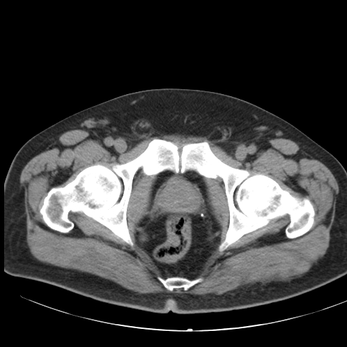 File:Appendicitis and giant appendicolith (Radiopaedia 80251-93588 Axial non-contrast 57).jpg