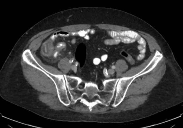 Appendicitis due to chicken fibula (Radiopaedia 74314-85198 A 24).jpg