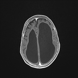 Aqueductal stenosis (Radiopaedia 73974-84802 Axial T1 C+ 108).jpg