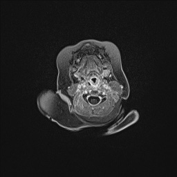 Aqueductal stenosis (Radiopaedia 73974-84802 Axial T1 C+ 12).jpg