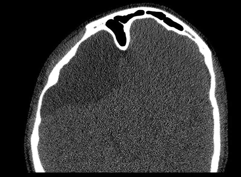 Arachnoid cyst- extremely large (Radiopaedia 68741-78450 Axial bone window 48).jpg