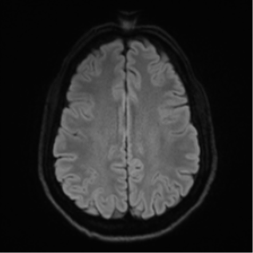 Arachnoid cyst - cerebellopontine angle (Radiopaedia 59689-67083 Axial DWI 61).png