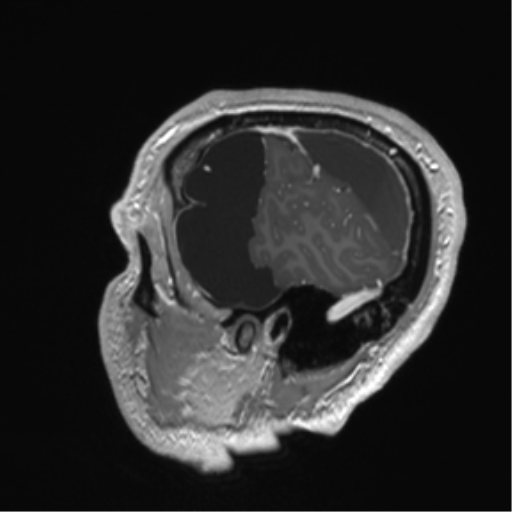 Arachnoid cyst with subdural hematoma (Radiopaedia 85892-101743 Sagittal T1 C+ 17).png