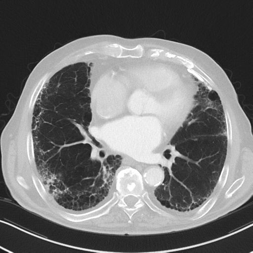 File:Asbestosis (Radiopaedia 56192-62864 Axial lung window 38).png