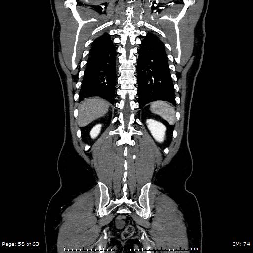File:Ascending aortic aneurysm (Radiopaedia 50086-55404 B 58).jpg