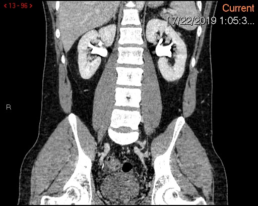 File:Ascending colonic diverticulum mimicking acute appendicitis (Radiopaedia 69943-80198 B 96).jpg