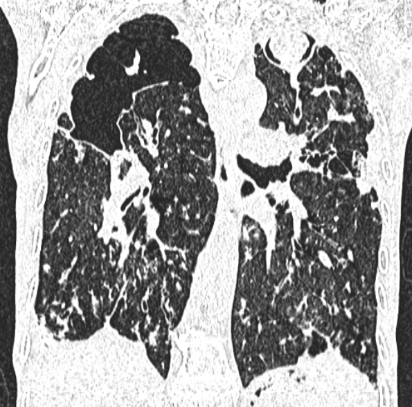 Aspergilloma- with Monod sign (Radiopaedia 44737-48532 Coronal lung window 282).jpg