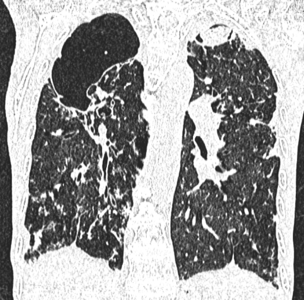 Aspergilloma- with Monod sign (Radiopaedia 44737-48532 Coronal lung window 299).jpg