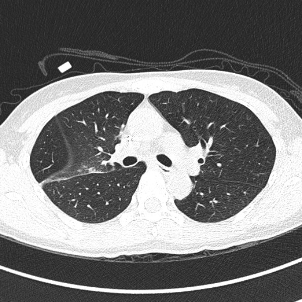 File:Aspergilloma (Radiopaedia 26223-26347 Axial lung window 33).jpg