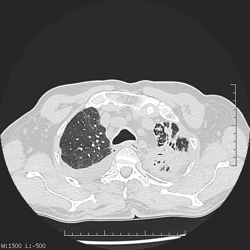 File:Aspergilloma (Radiopaedia 75184-86270 Axial lung window 10).jpg