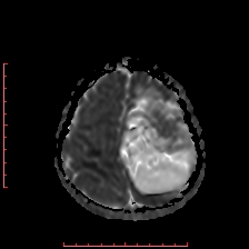 Astroblastoma (Radiopaedia 74287-85162 Axial ADC 56).jpg