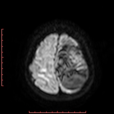 File:Astroblastoma (Radiopaedia 74287-85162 Axial DWI 93).jpg
