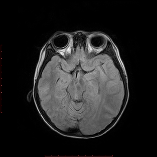 File:Astroblastoma (Radiopaedia 74287-85162 Axial FLAIR 8).jpg