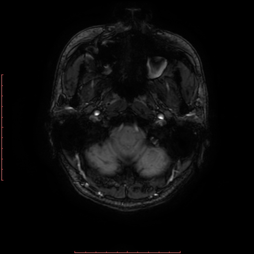 Astrocytoma NOS - cystic (Radiopaedia 59089-66384 Axial SWI 4).jpg