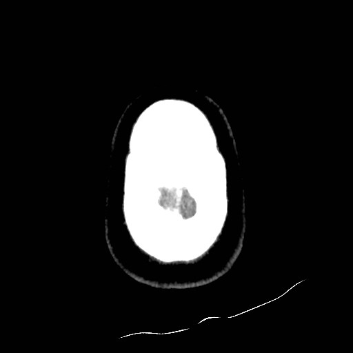 File:Atlanto-occipital dislocation (Radiopaedia 44648-48412 Axial non-contrast 52).jpg