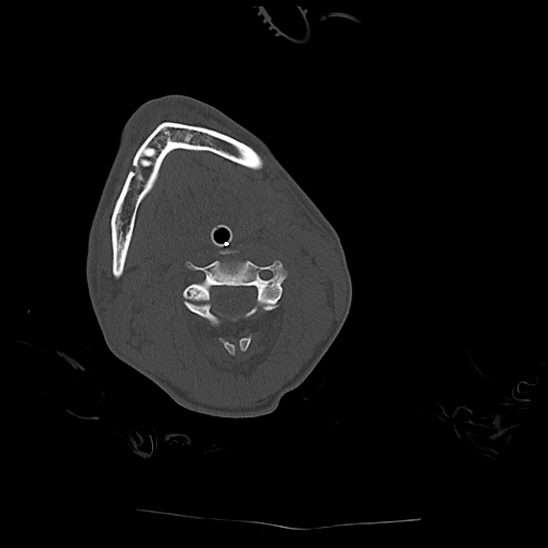 File:Atlanto-occipital dissociation (Traynelis type 1), C2 teardrop fracture, C6-7 facet joint dislocation (Radiopaedia 87655-104061 Axial bone window 38).jpg