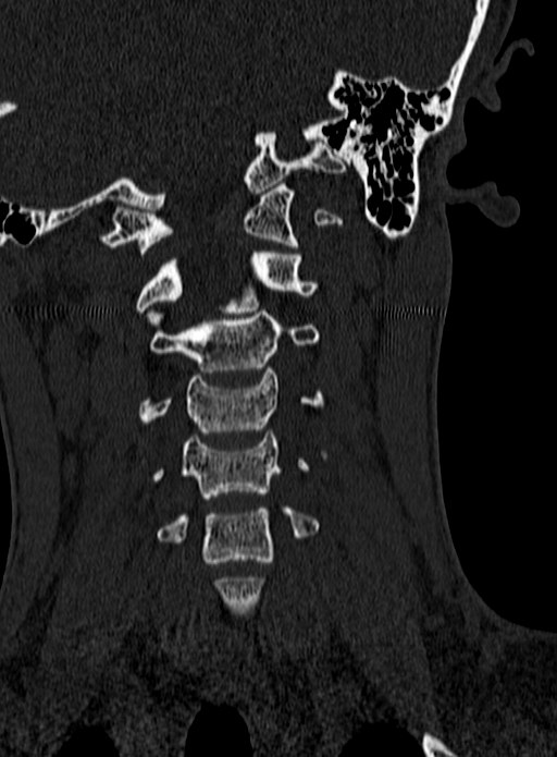 Atlantoaxial subluxation (Radiopaedia 44681-48450 Coronal bone window 50).jpg