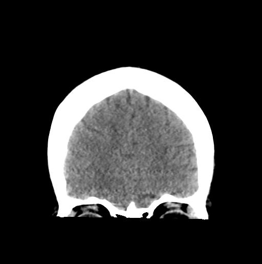 File:Atretic encephalocoele with inferior vermis hypoplasia (Radiopaedia 30443-31107 Coronal non-contrast 9).jpg