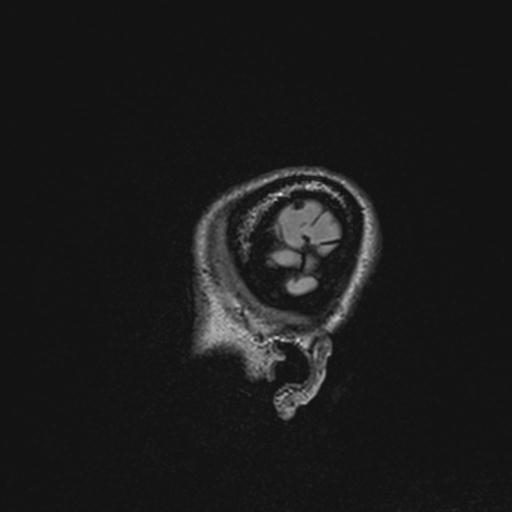 Atretic encephalocoele with inferior vermis hypoplasia (Radiopaedia 30443-31108 Sagittal FLAIR 19).jpg