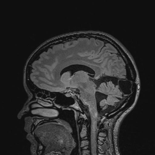 Atretic encephalocoele with inferior vermis hypoplasia (Radiopaedia 30443-31108 Sagittal FLAIR 87).jpg