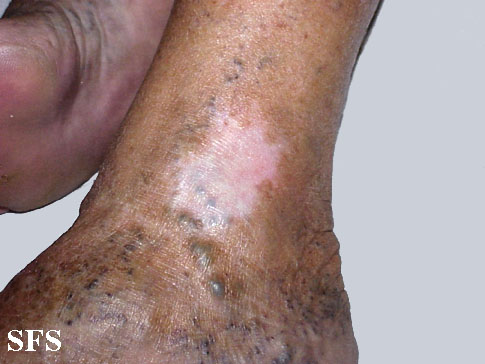 Atrophie Blanche (Dermatology Atlas 3).jpg