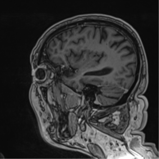 Atypical meningioma (WHO grade II) with brain invasion (Radiopaedia 57767-64729 Sagittal T1 C+ 23).png