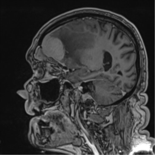 Atypical meningioma (WHO grade II) with brain invasion (Radiopaedia 57767-64729 Sagittal T1 C+ 44).png
